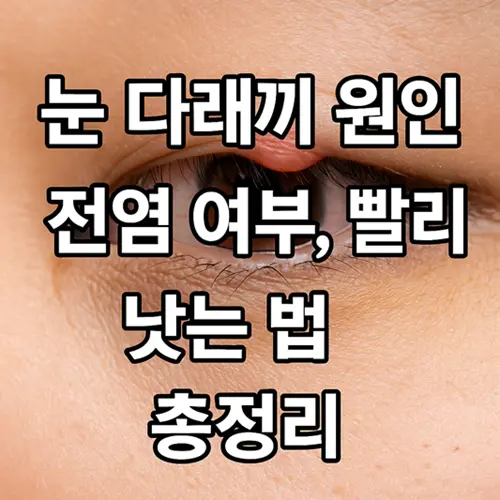 눈 다래끼 원인, 전염 여부, 빨리 낫는 법