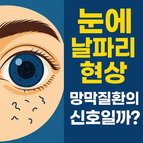 눈에 날파리 현상(비문증) 원인과 대처방법